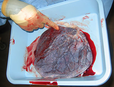 375px-Human_placenta_baby_side.jpg