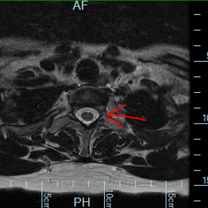 cross section of unsquashed nerve