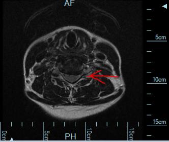 cross section of squashed nerve