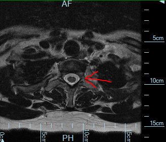 cross section of unsquashed nerve