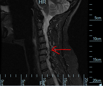 neck mri2